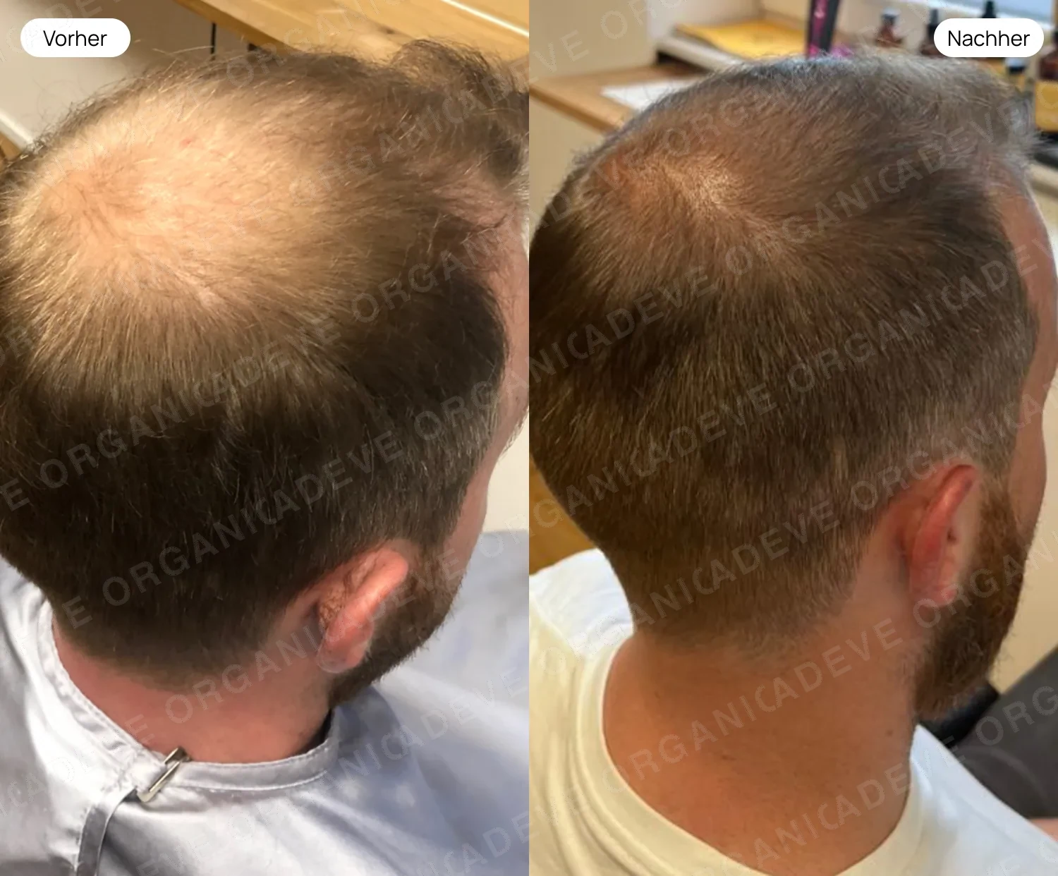 Vorher Nachher: Starker männlicher Haarausfall – sichtbar gepflegtes Haar nach ADEVE Methode