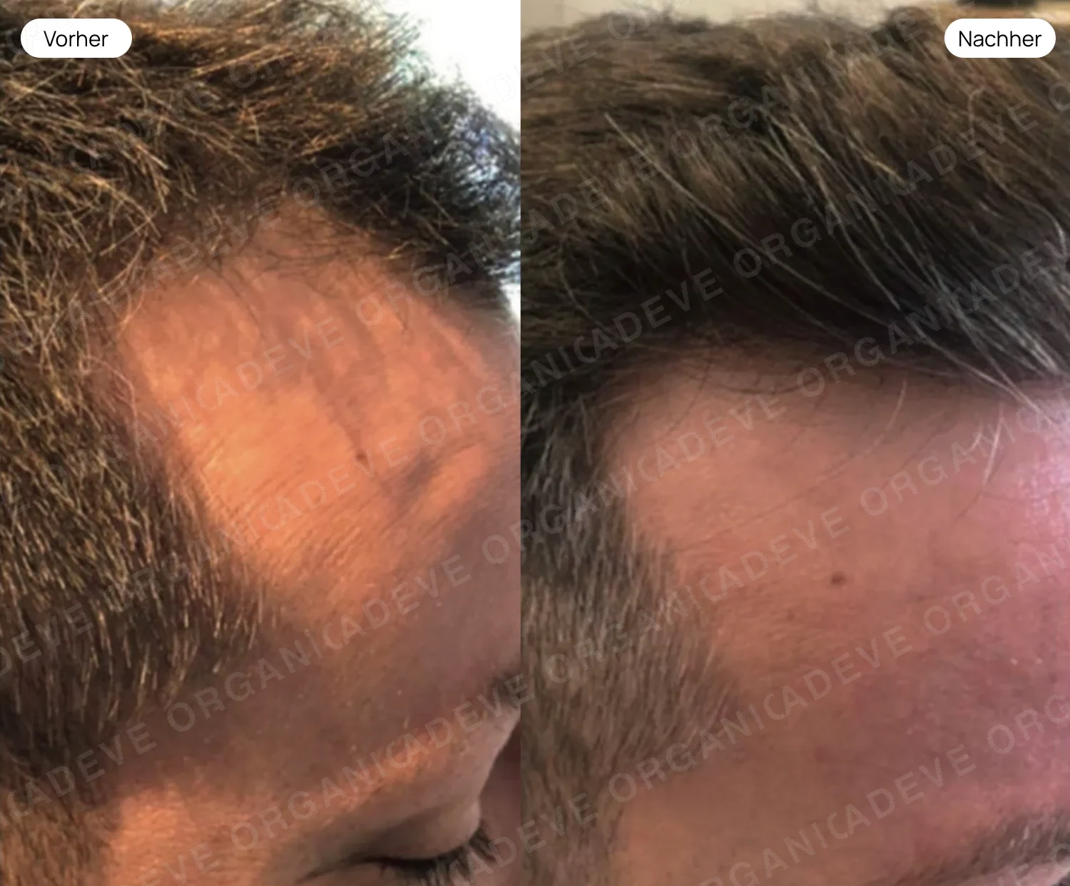 Vorher Nachher: Männliche Haarlinie – sichtbar gepflegteres Haarbild nach ADEVE Methode