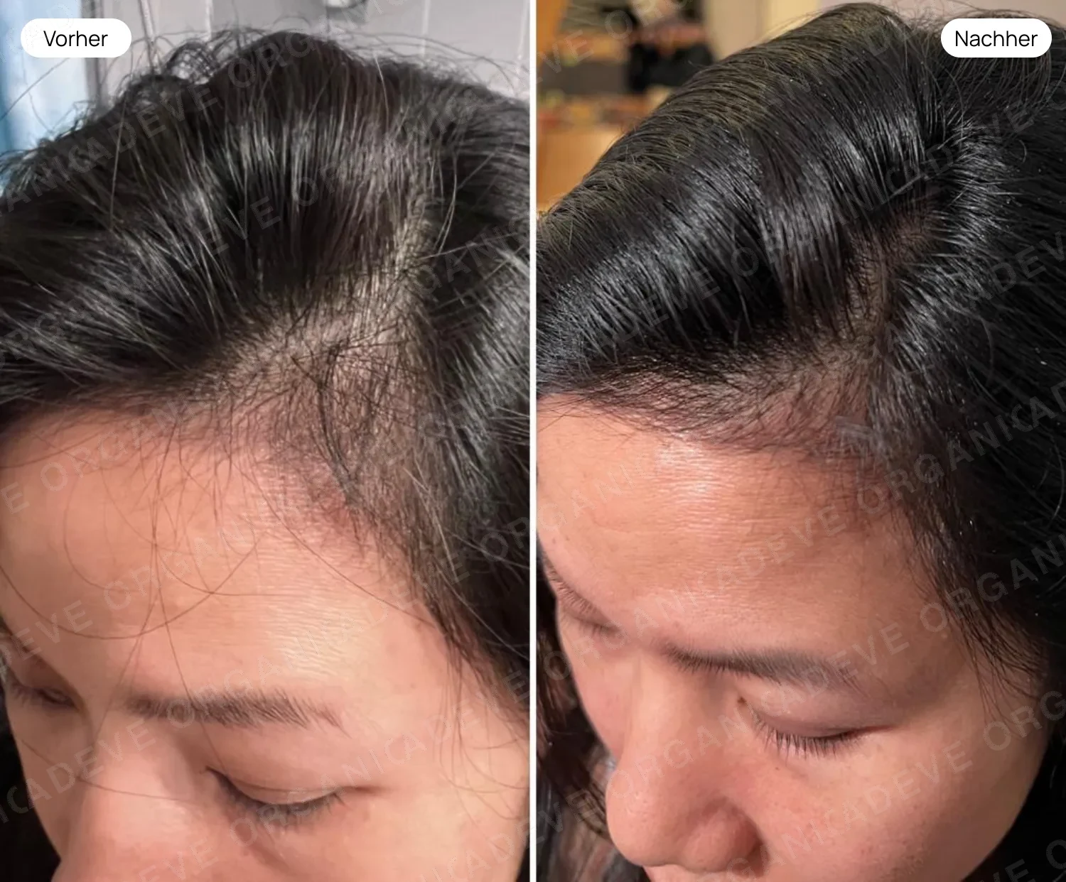 Vorher Nachher: Haarausfall bei Frauen – Kopfhautbild nach ADEVE Pflege sichtbar verbessert
