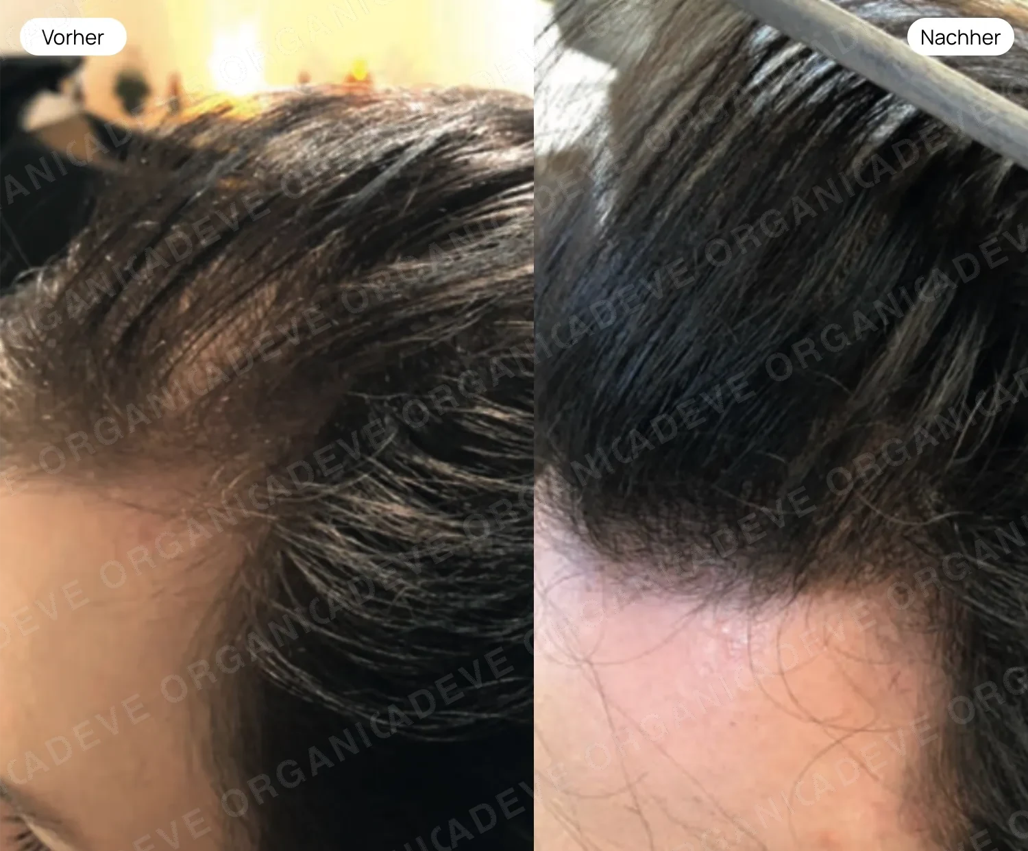 Vorher Nachher: Weiblicher Haarausfall an Stirnlinie – Haarbild wirkt deutlich voller